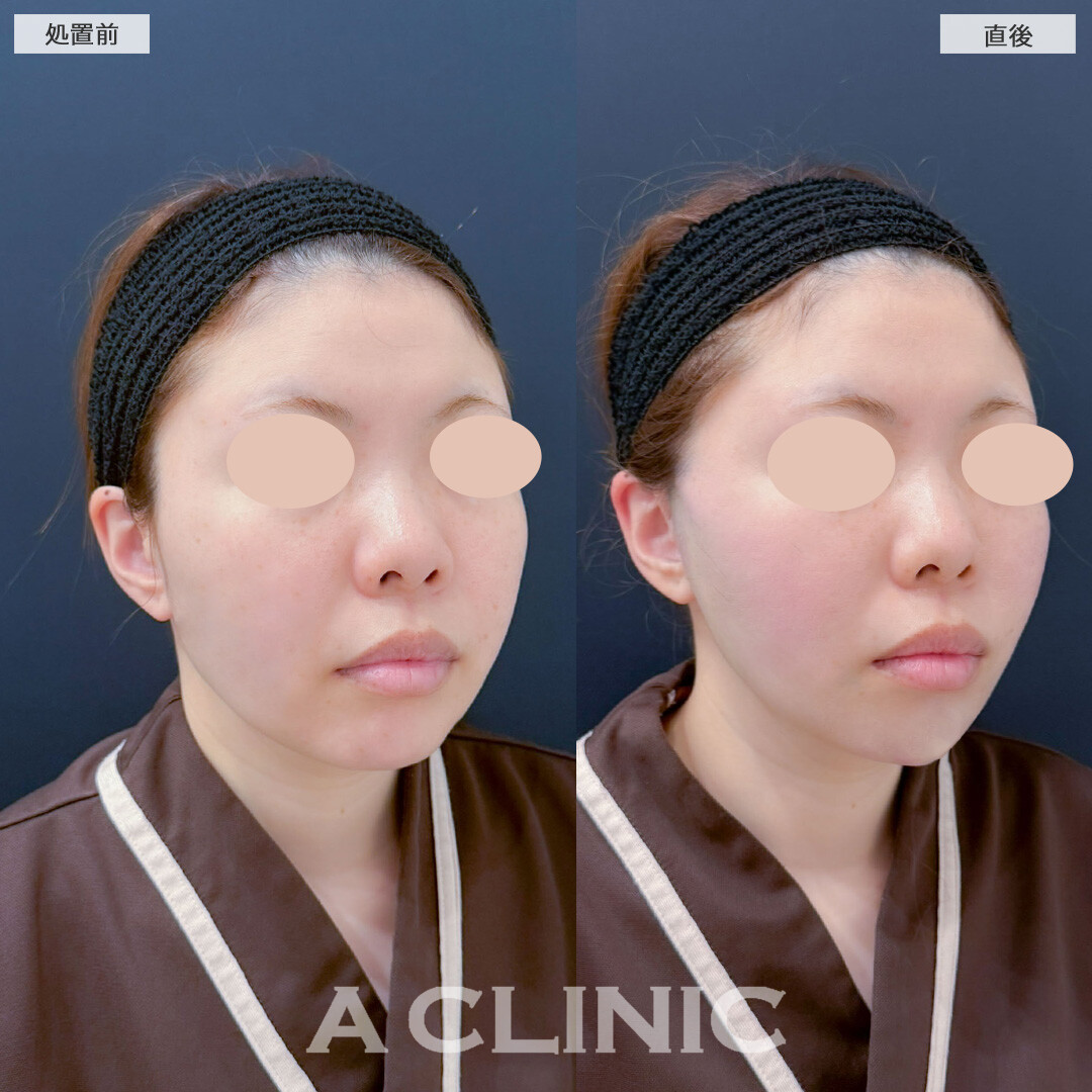 Aスレッドとあごへのヒアルロン酸注入で直後からダウンタイム少なくEラインが整いました！こちら処置前と直後の症例です(30代女性)
