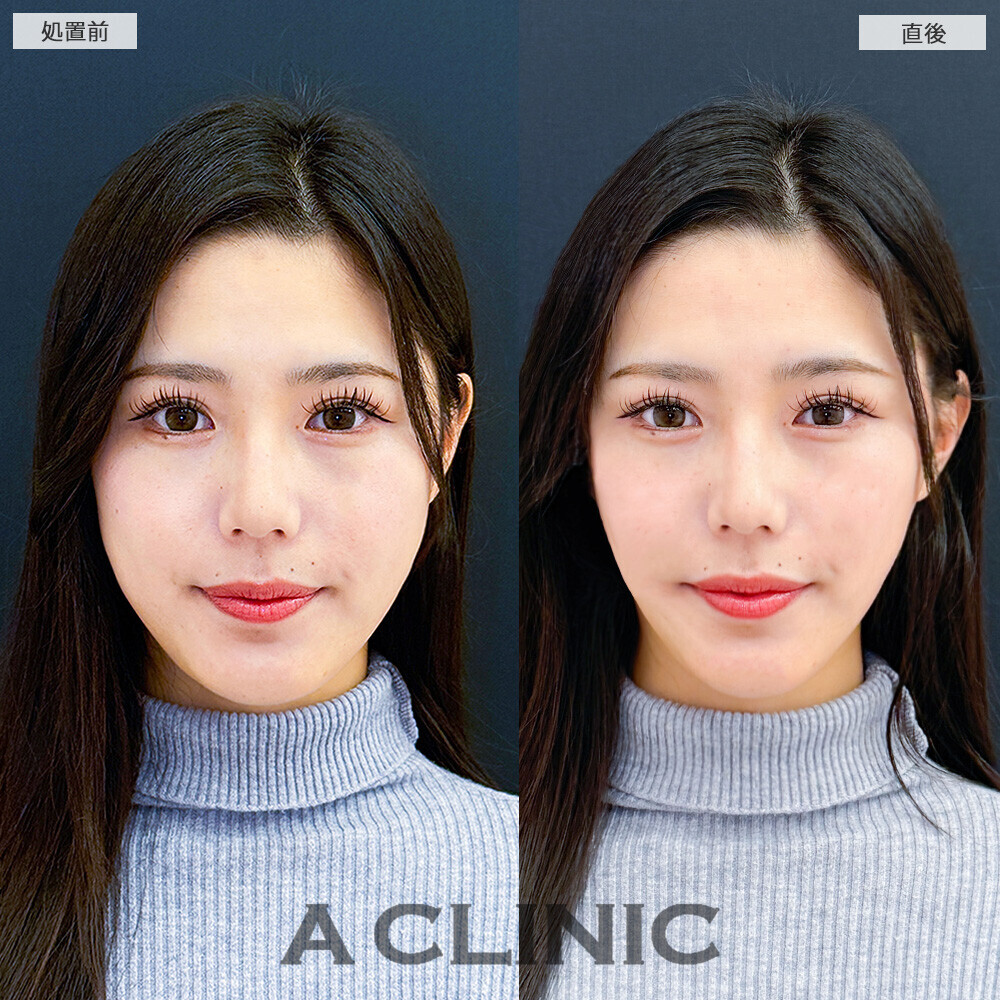 Aスレッドでフェイスラインがよりスッキリ！こちら処置前と直後の症例です(20代女性)