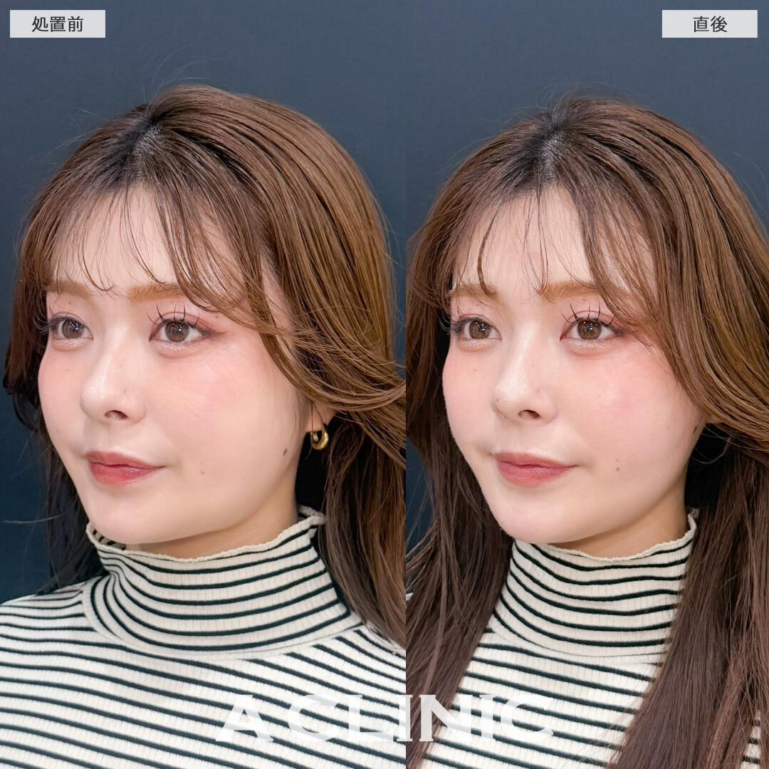 Aスレッドはフェイスラインを整えるメンテナンスに最適です！こちら処置前と直後の症例です(20代女性)