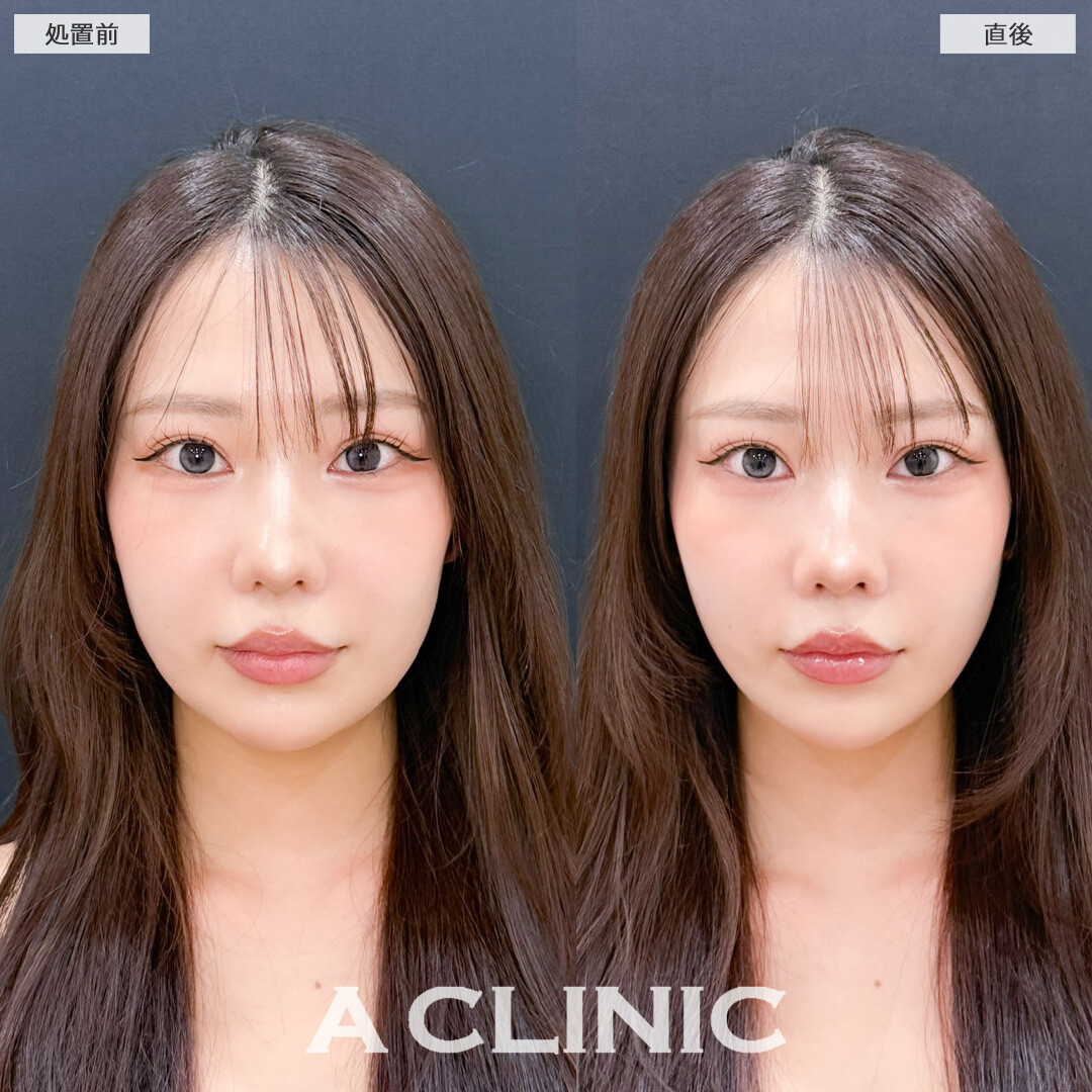 Aスレッドとヒアルロン酸注射(シワ)でお疲れ顔も一気に復活します！こちら処置前と直後の症例です(20代女性)
