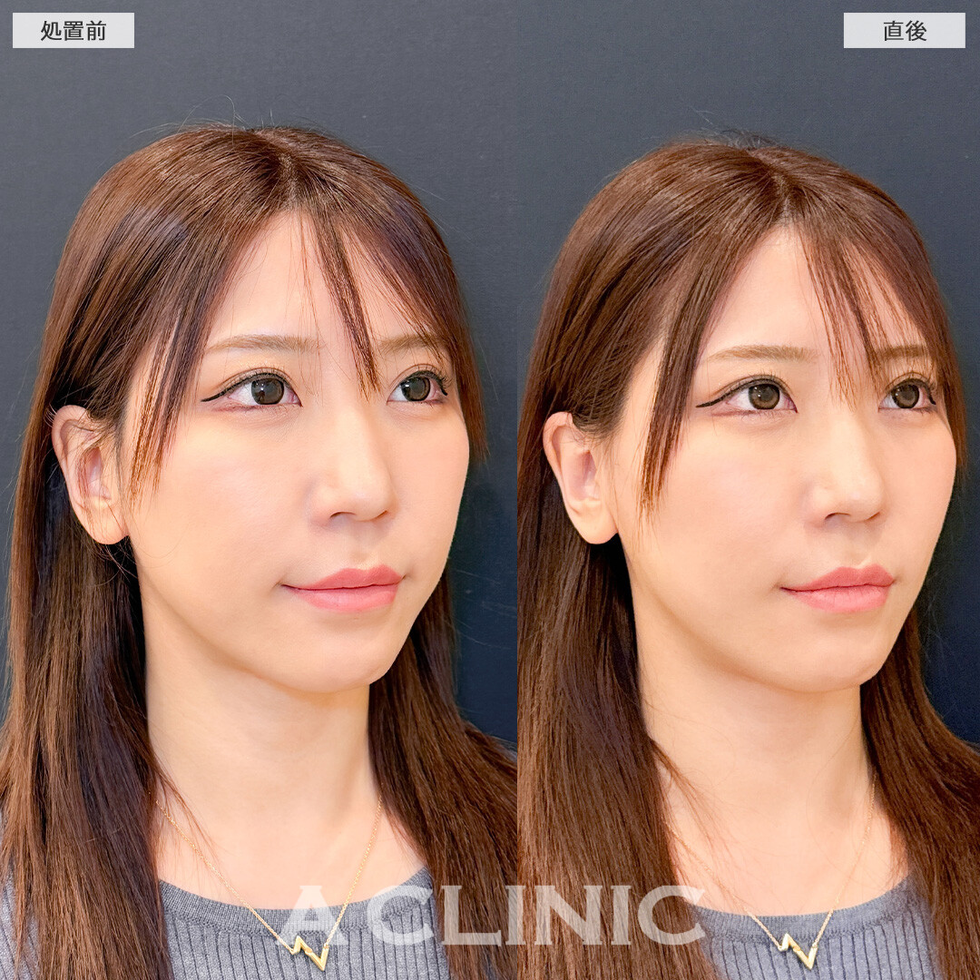 Aスレッドで気になり始めたお顔の下部分を引き上げます！こちら処置前と直後の症例です(30代女性)