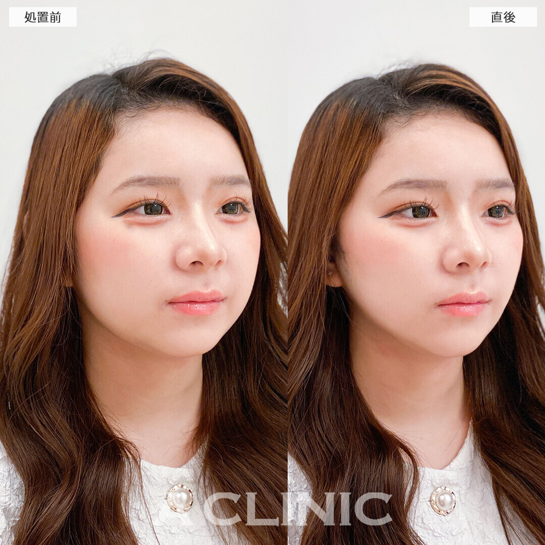 Aスレッドは将来のたるみ予防にも効果的！こちら処置前と直後の症例です(10代女性)