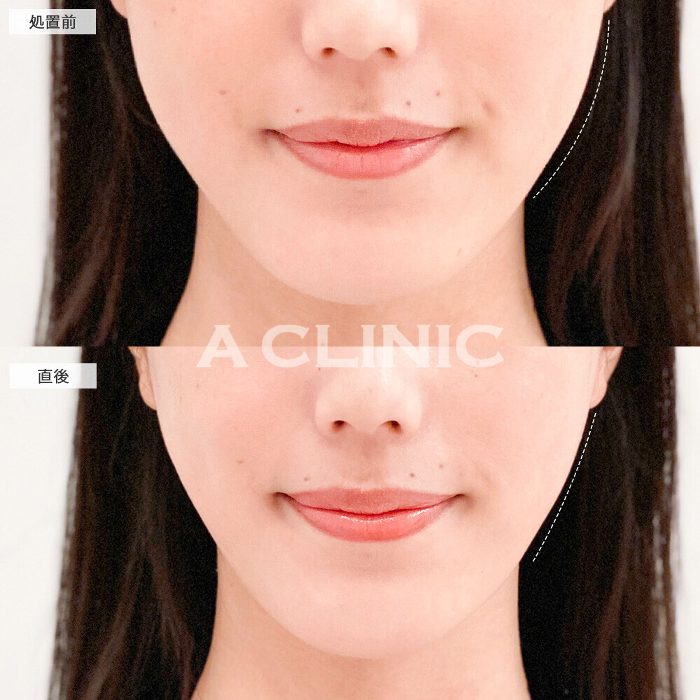 Aスレッドで小顔が更に小顔に！こちら処置前と直後の症例です(20代女性)