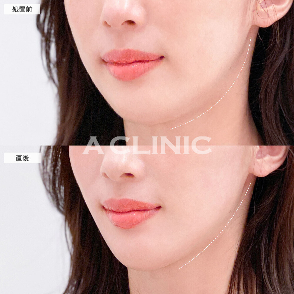 Aスレッドで少しのたるみも逃さずしっかりリフトアップ！こちら処置前と直後の症例です(30代女性)