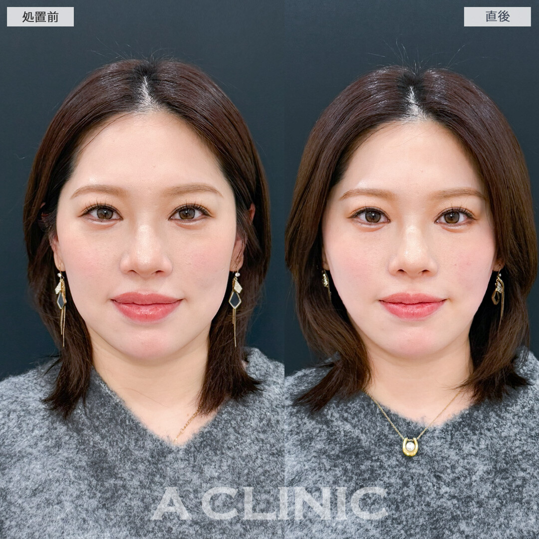 Aスレッドは将来のたるみ予防にもおすすめ！処置前と直後の症例です(30代女性)