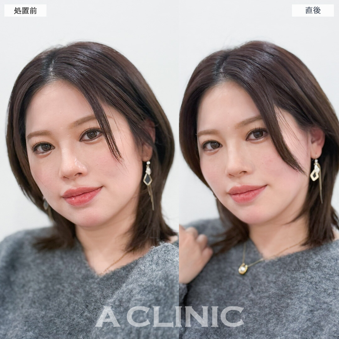 Aスレッドは将来のたるみ予防にもおすすめ！処置前と直後の症例です(30代女性)