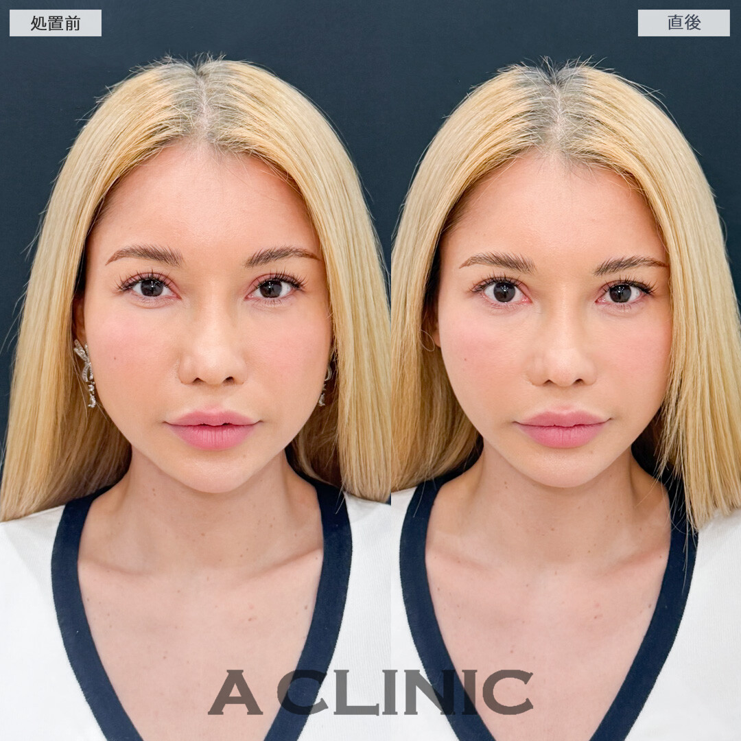 Aスレッドで年齢が出やすい口元もしっかり引き上げてほうれい線が薄くなりなした！処置前と直後の症例です(40代女性)