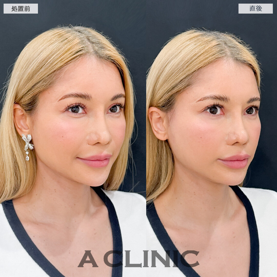 Aスレッドで年齢が出やすい口元もしっかり引き上げてほうれい線が薄くなりなした！処置前と直後の症例です(40代女性)