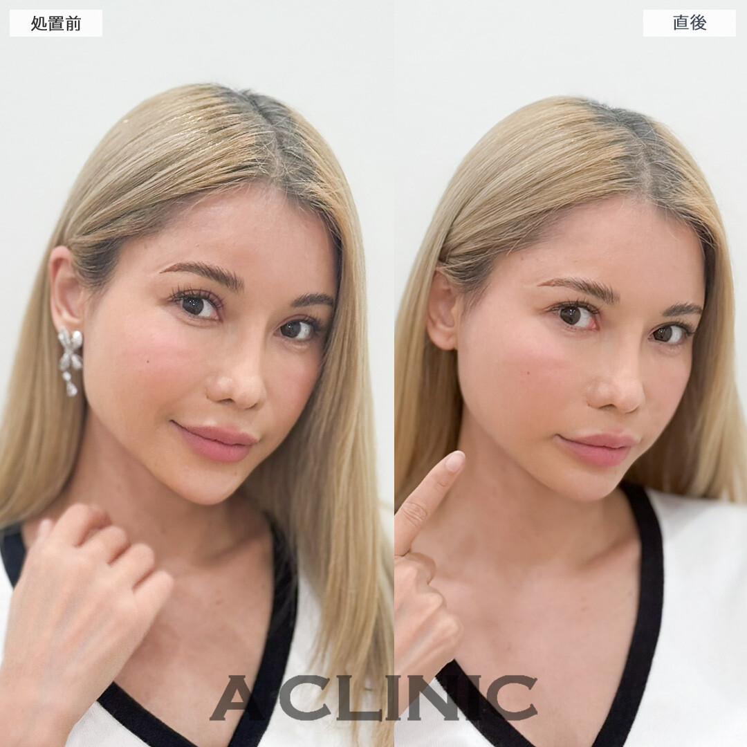 Aスレッドで年齢が出やすい口元もしっかり引き上げてほうれい線が薄くなりなした！処置前と直後の症例です(40代女性)