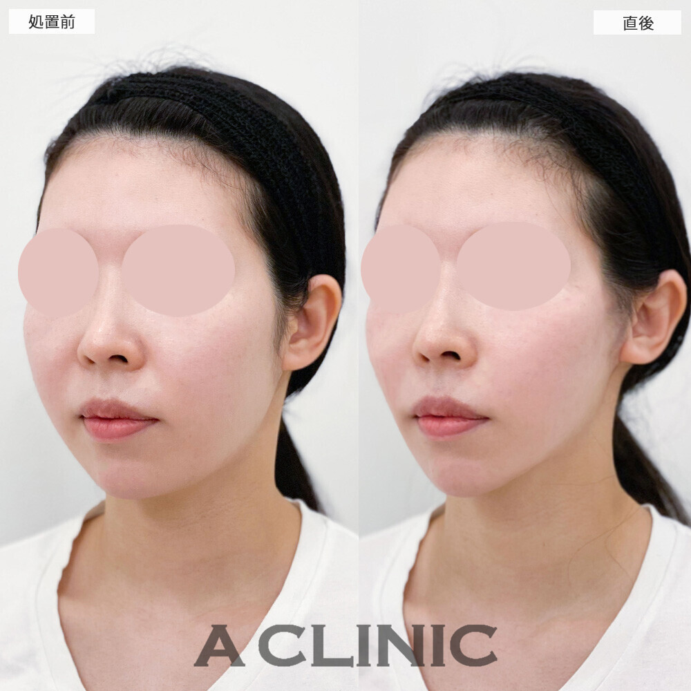 Aスレッドでメリハリがなかった輪郭がアゴにかけてシュッとしました！こちら処置前と直後の症例です(20代女性)
