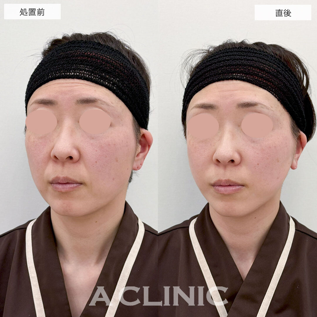 Aスレッドでほうれい線を引き上げて若見え効果!こちら処置前と直後の症例です(40代女性)