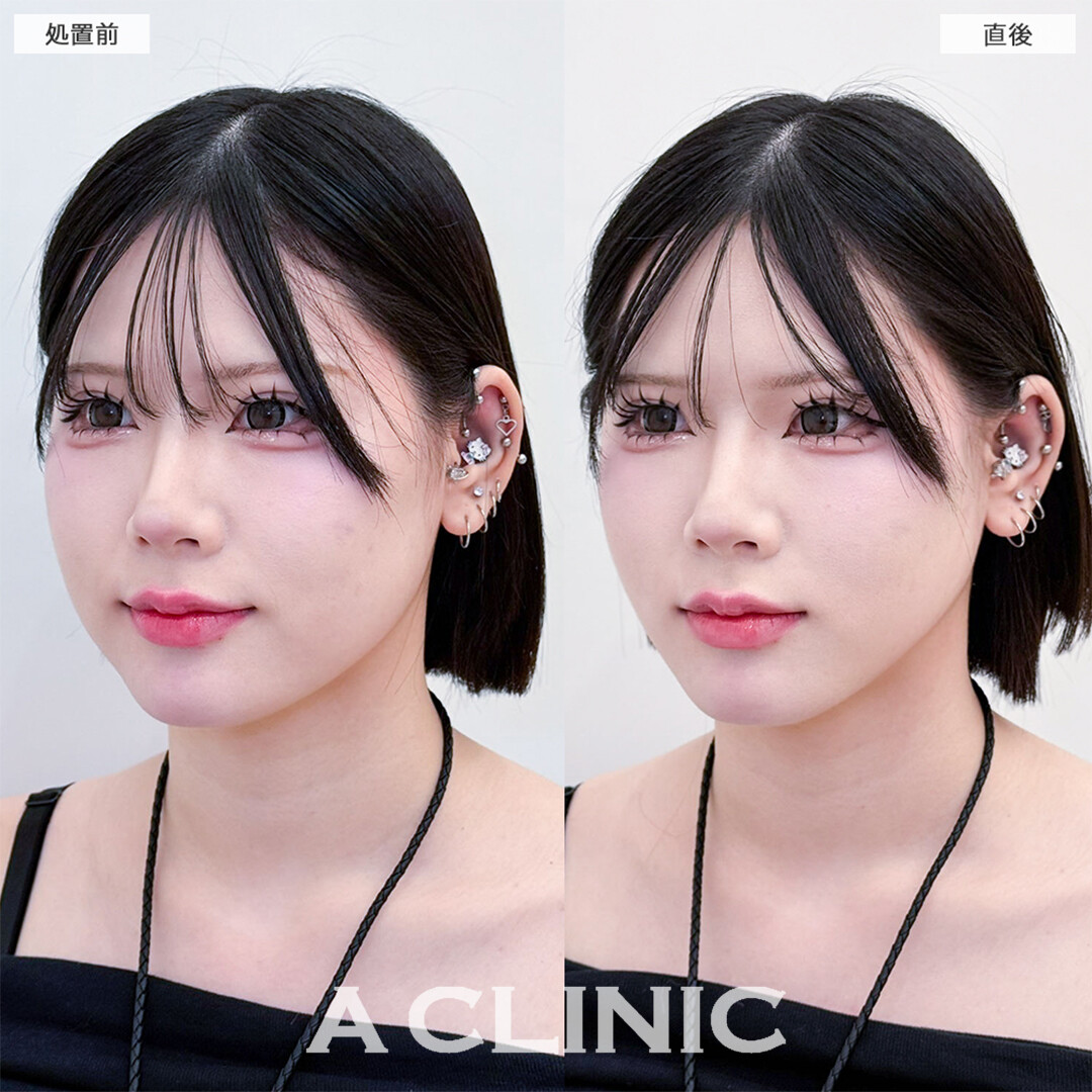 Aスレッドは施術直後から卵形フェイスになれます！こちら処置前と直後の症例です(20代女性)
