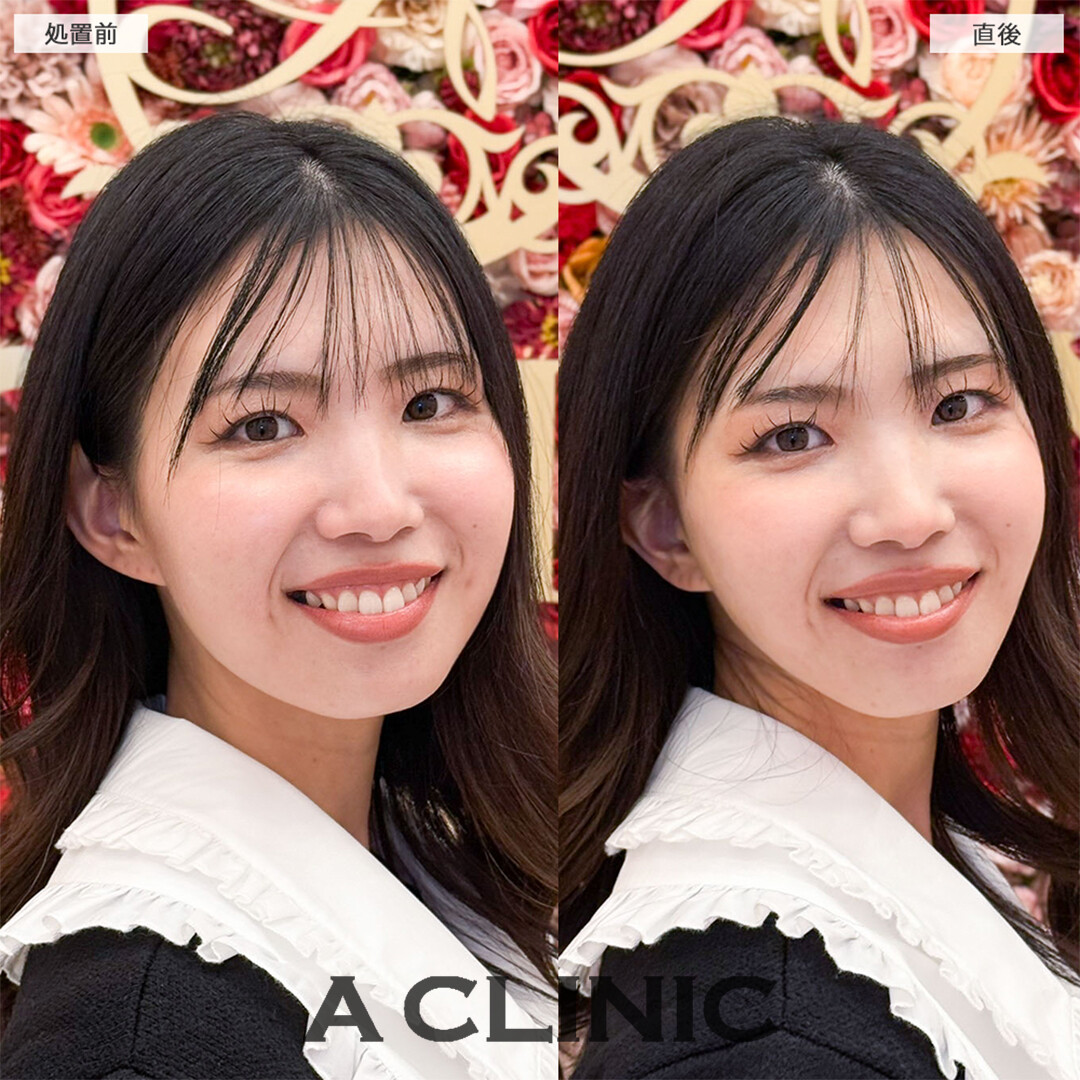 Aスレッドで左右差や口横のたるみが解消！こちら処置前と直後の症例です(30代女性)
