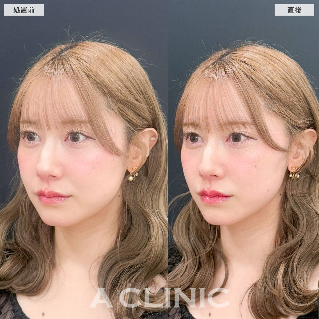 Aスレッドは短時間で垢抜けが叶います！こちら処置前と直後の症例です(30代女性)