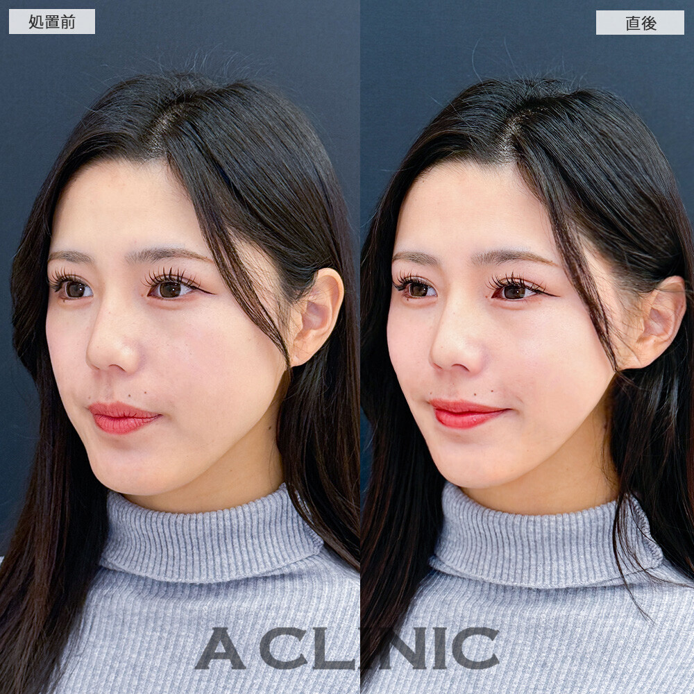 Aスレッドでフェイスラインがよりスッキリ！こちら処置前と直後の症例です(20代女性)