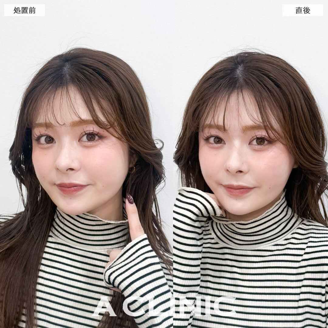 Aスレッドはフェイスラインを整えるメンテナンスに最適です！こちら処置前と直後の症例です(20代女性)