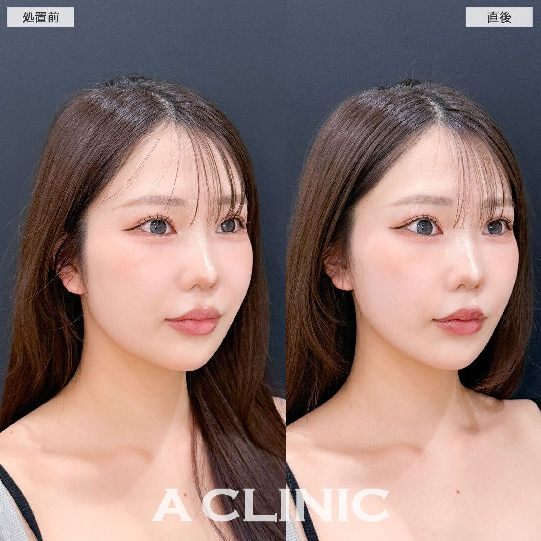 Aスレッドとヒアルロン酸注射(シワ)でお疲れ顔も一気に復活します！こちら処置前と直後の症例です(20代女性)
