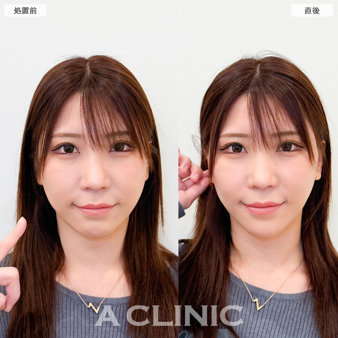 Aスレッドで気になり始めたお顔の下部分を引き上げます！こちら処置前と直後の症例です(30代女性)