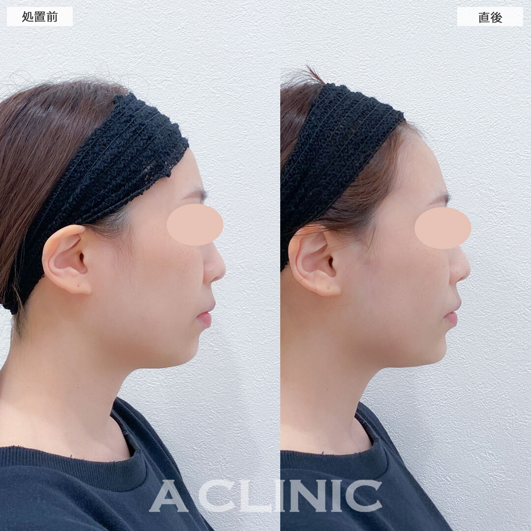 Aスレッドとあごへのヒアルロン酸注入で直後から輪郭が綺麗に整いました！こちら処置前と直後の症例です(20代女性)