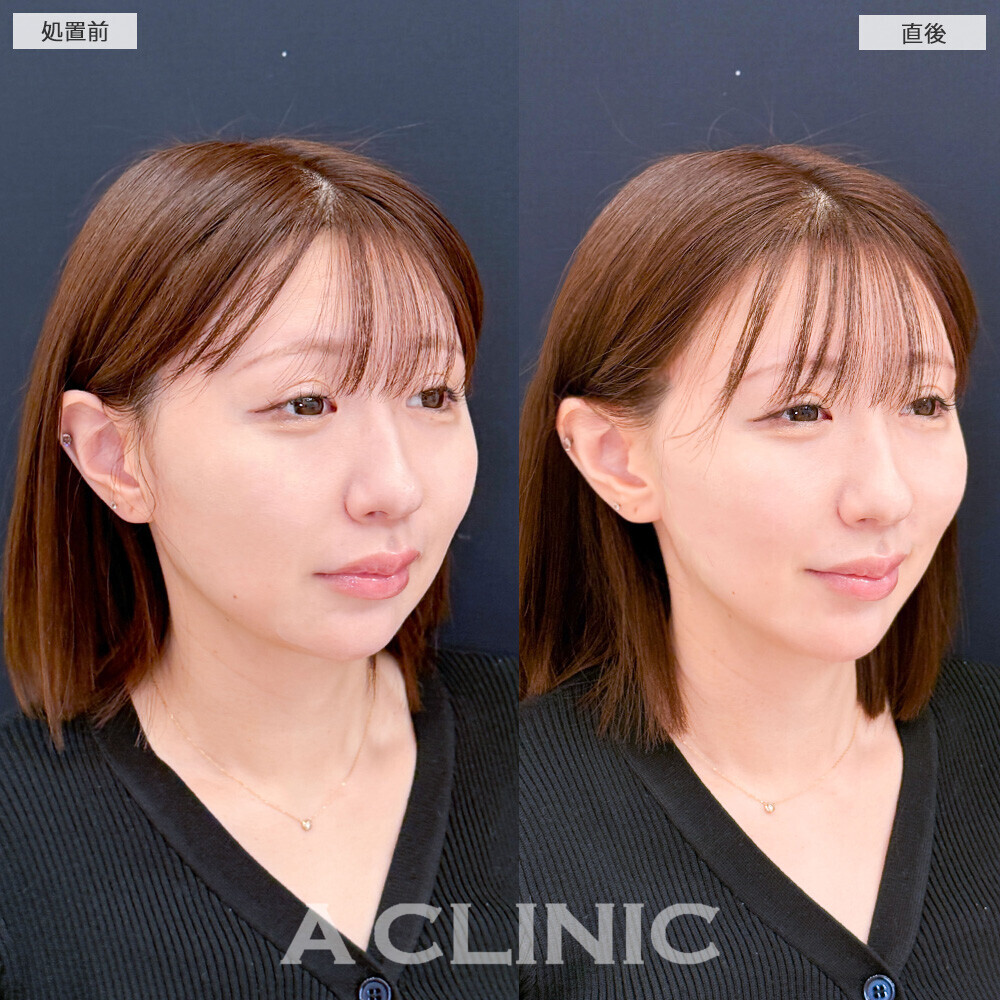Aスレッドで1day小顔後のメンテナンスで更にリフトアップ！こちら処置前と直後の症例です(30代女性)