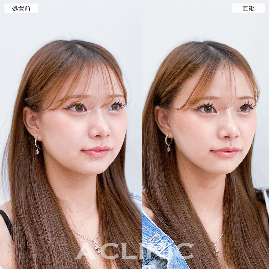 Aスレッドで丸顔解消されました！こちら処置前と直後の症例です(10代女性)