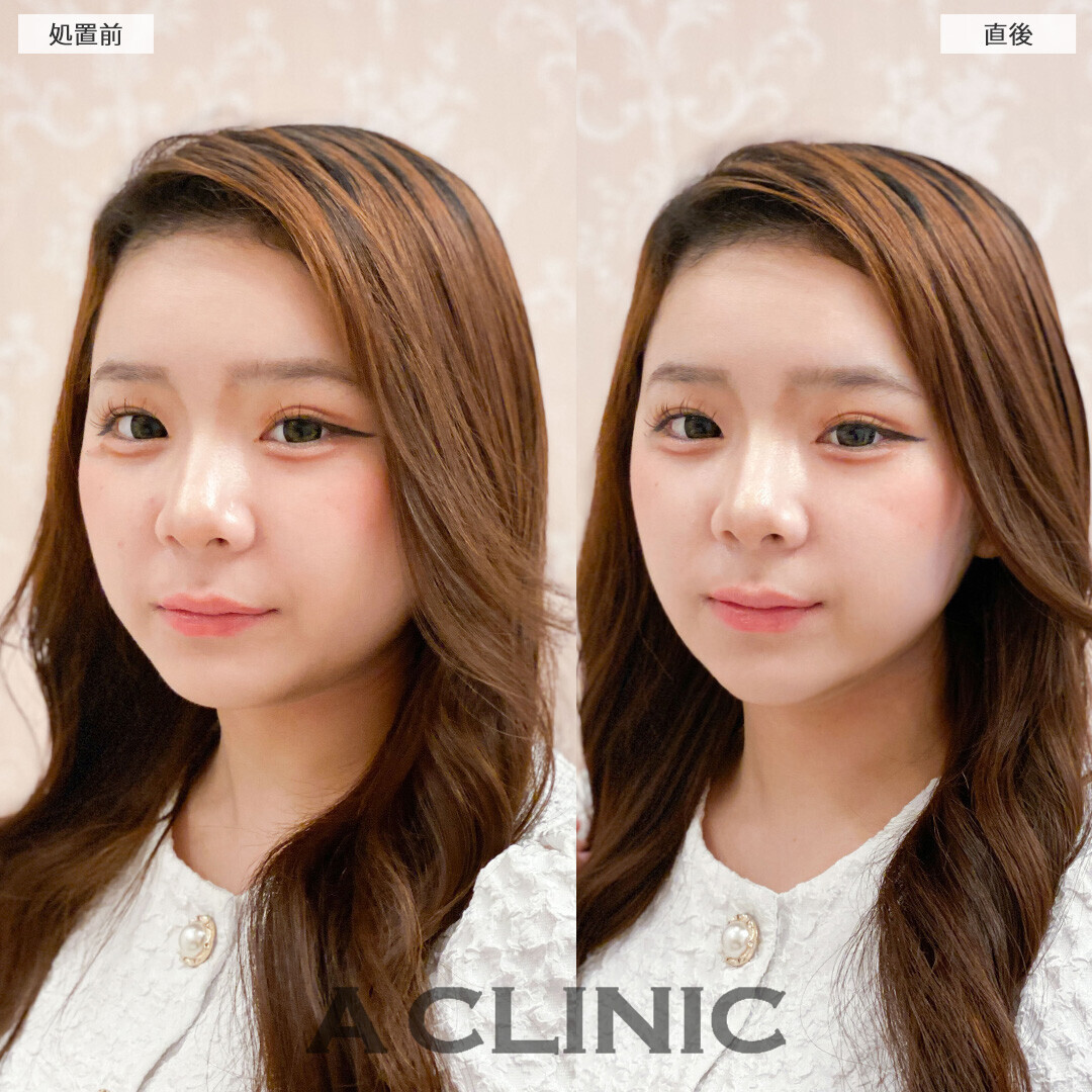 Aスレッドは将来のたるみ予防にも効果的！こちら処置前と直後の症例です(10代女性)