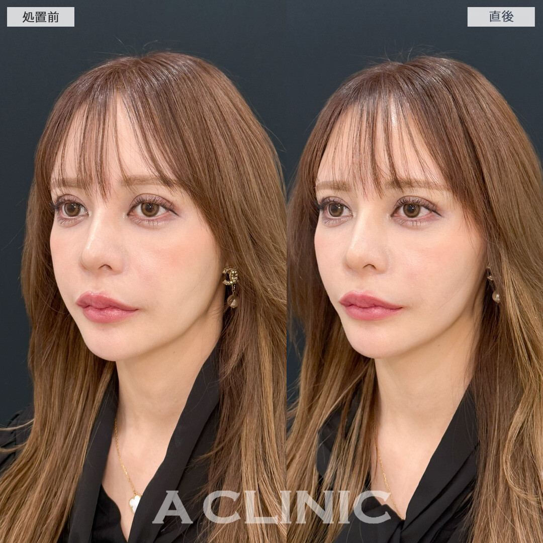 Aスレッドでもたつきが引きあがり一気に若見えします！処置前と直後の症例です(30代女性)