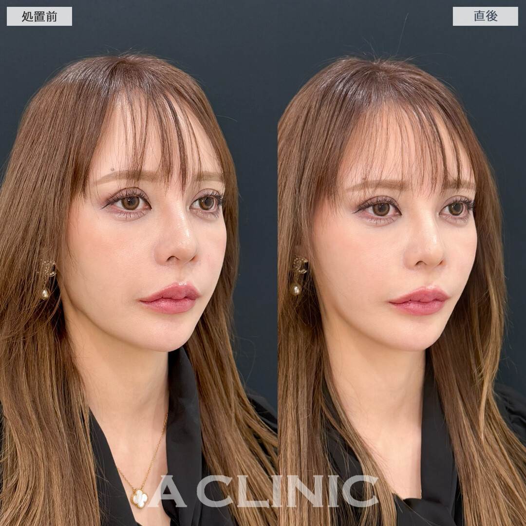 Aスレッドでもたつきが引きあがり一気に若見えします！処置前と直後の症例です(30代女性)