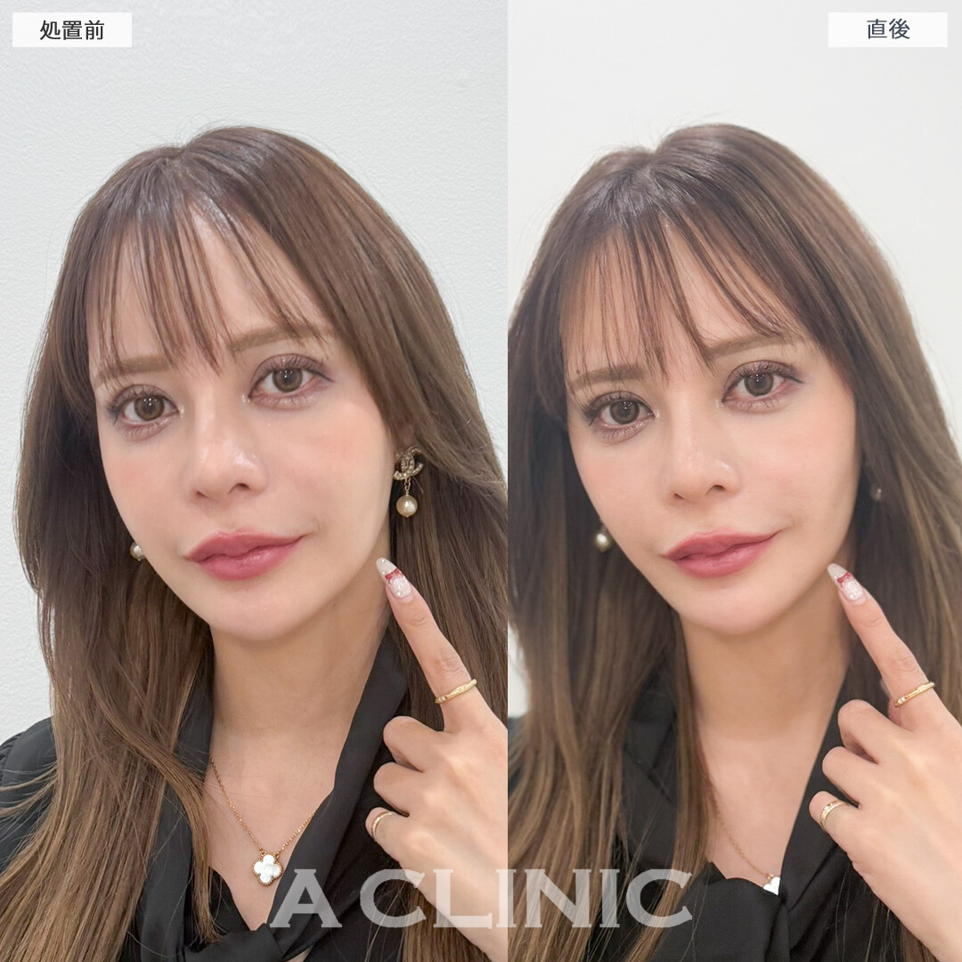 Aスレッドでもたつきが引きあがり一気に若見えします！処置前と直後の症例です(30代女性)