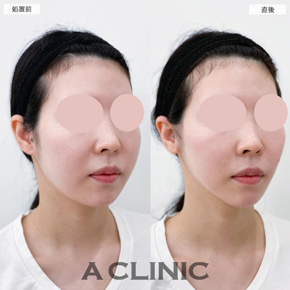 Aスレッドでメリハリがなかった輪郭がアゴにかけてシュッとしました！こちら処置前と直後の症例です(20代女性)