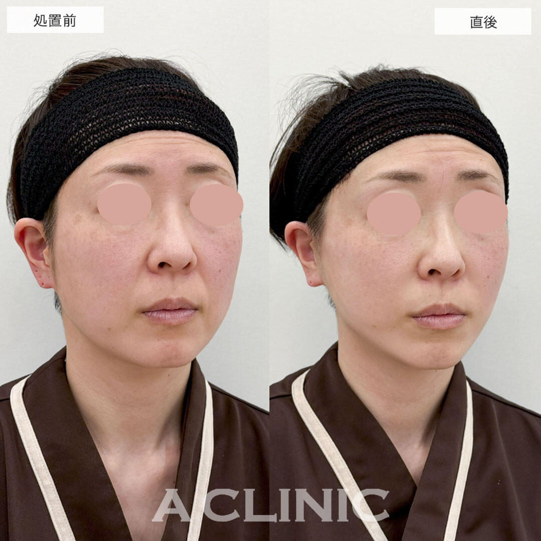 Aスレッドでほうれい線を引き上げて若見え効果!こちら処置前と直後の症例です(40代女性)