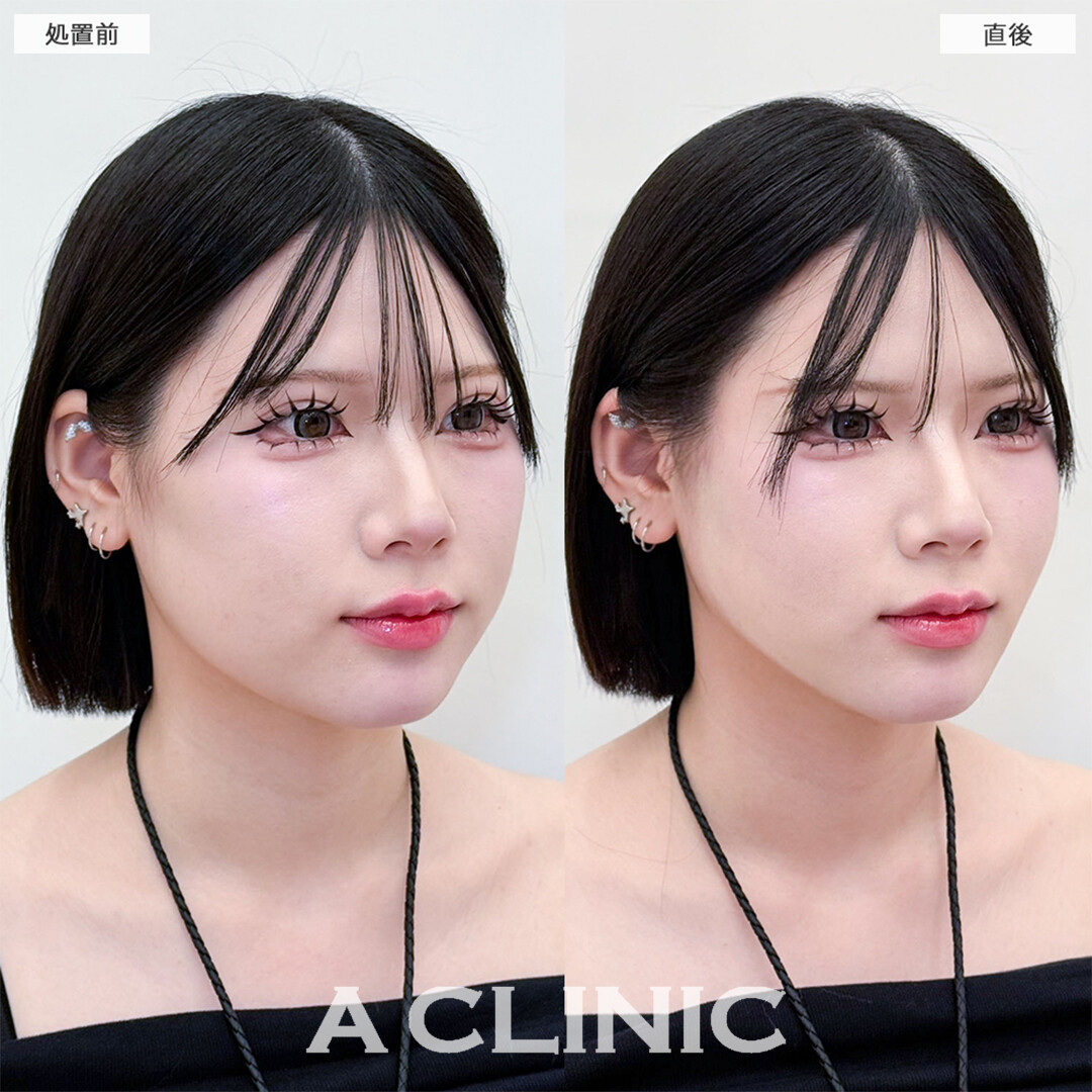 Aスレッドは施術直後から卵形フェイスになれます！こちら処置前と直後の症例です(20代女性)