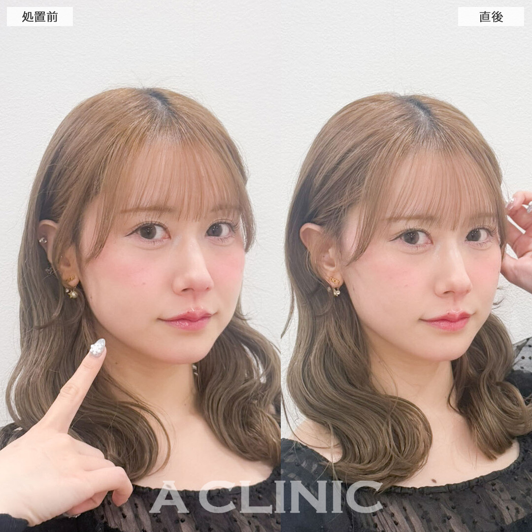 Aスレッドは短時間で垢抜けが叶います！こちら処置前と直後の症例です(30代女性)