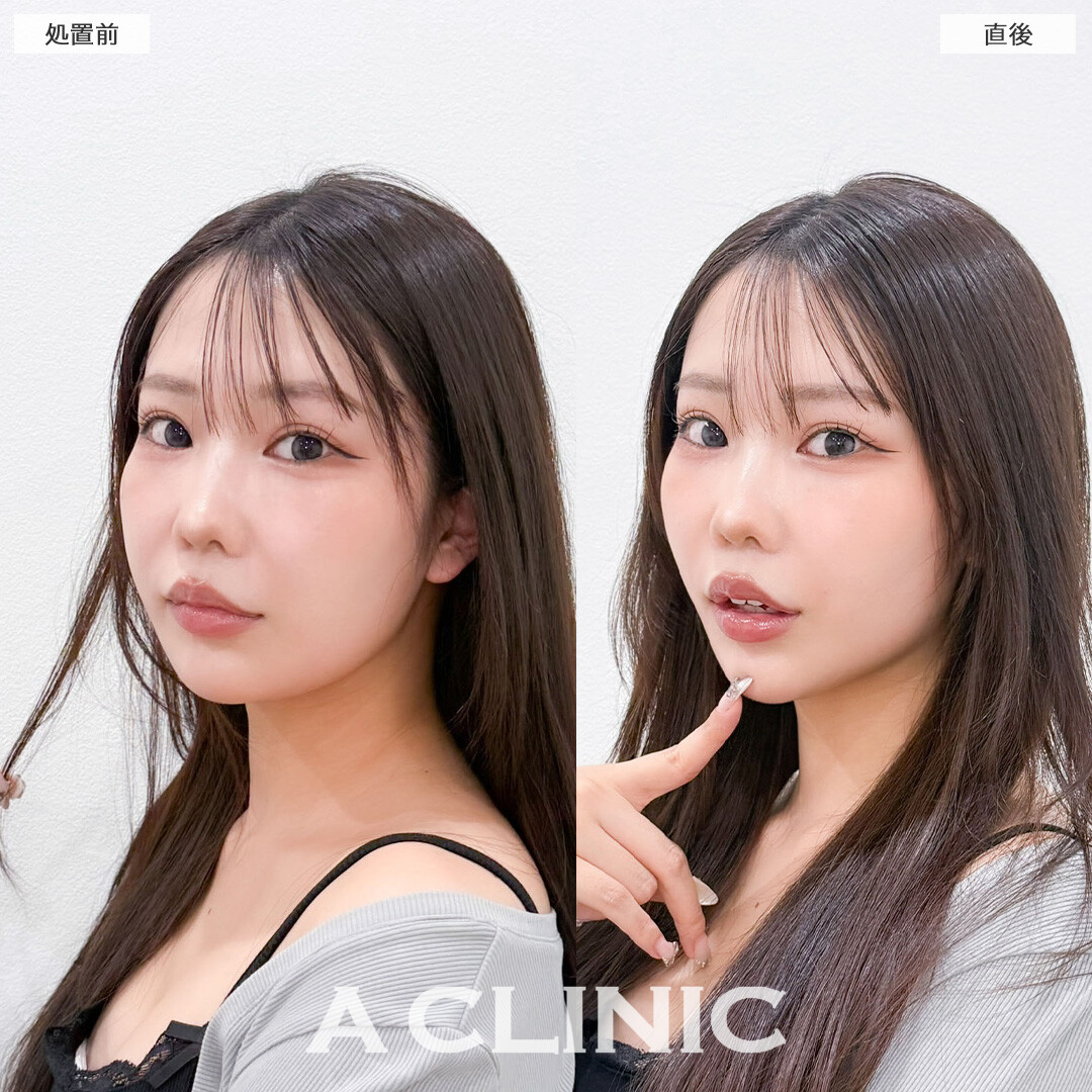 Aスレッドとヒアルロン酸注射(シワ)でお疲れ顔も一気に復活します！こちら処置前と直後の症例です(20代女性)