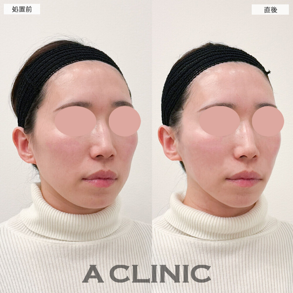 Aスレッドとエッグフェイスで頬コケ改善とリフトアップを同時に！こちら処置前と直後の症例です(30代女性)