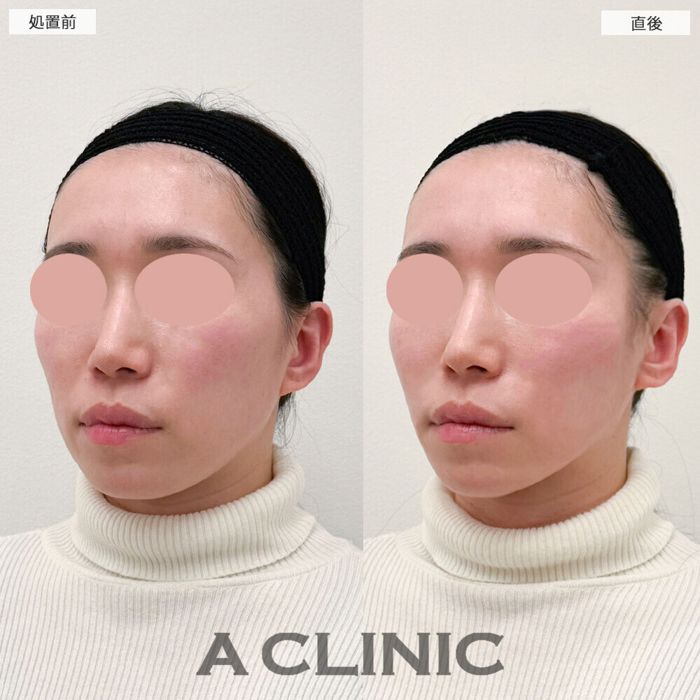 Aスレッドとエッグフェイスで頬コケ改善とリフトアップを同時に！こちら処置前と直後の症例です(30代女性)