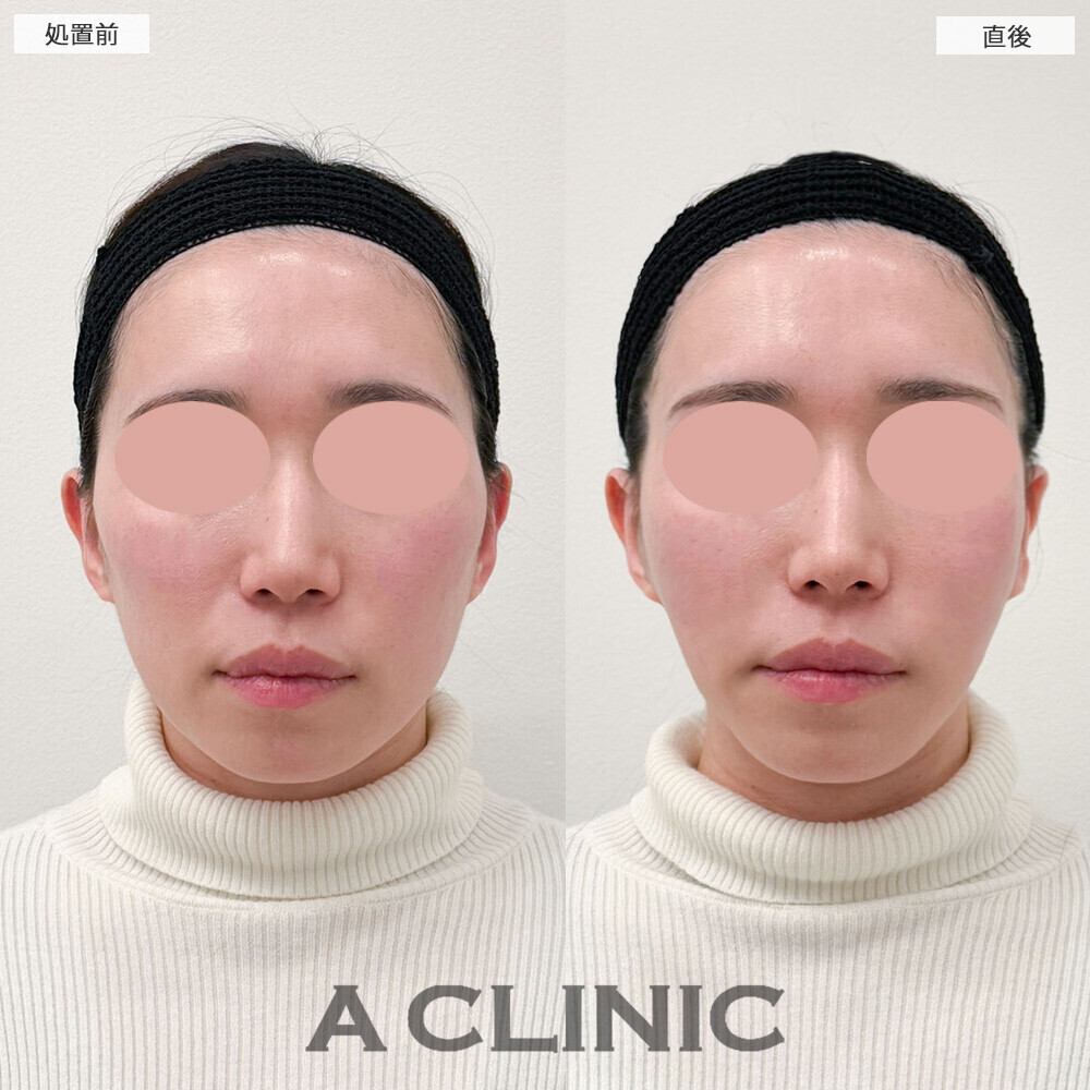 Aスレッドとエッグフェイスで頬コケ改善とリフトアップを同時に！こちら処置前と直後の症例です(30代女性)