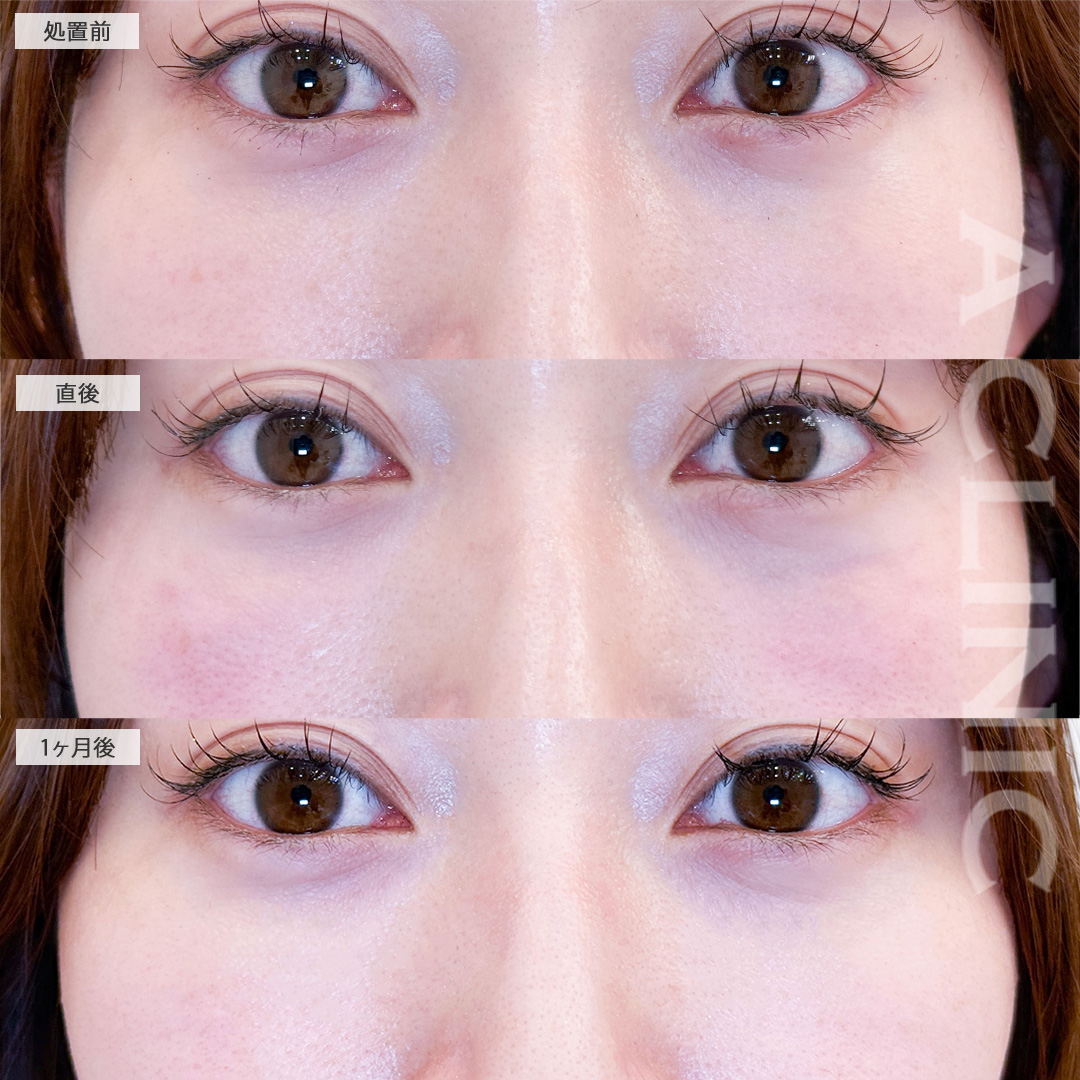 美肌サーモンスレッドで小ジワやくすみが飛び明るい目元に！こちら処置前から1ヶ月後の症例です(20代女性)