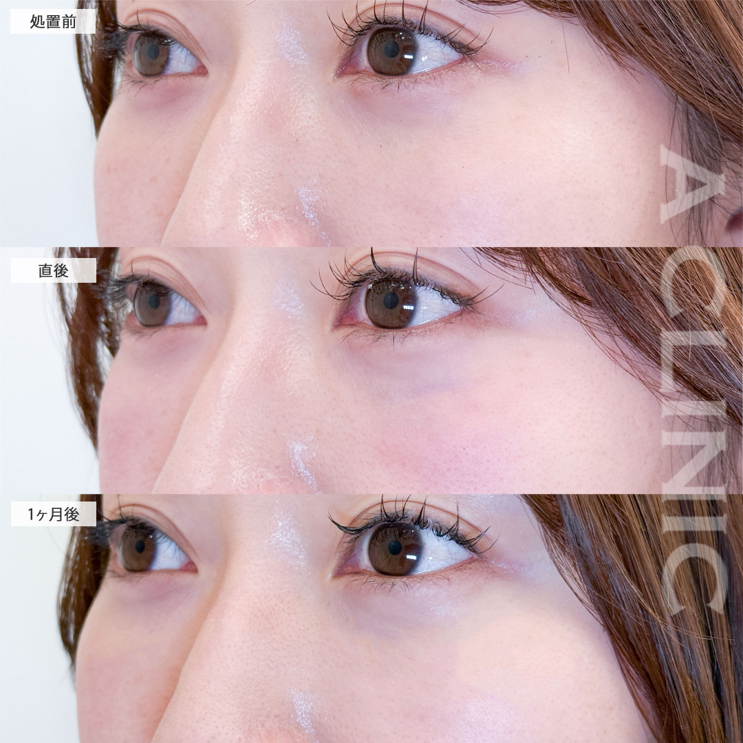 美肌サーモンスレッドで小ジワやくすみが飛び明るい目元に！こちら処置前から1ヶ月後の症例です(20代女性)
