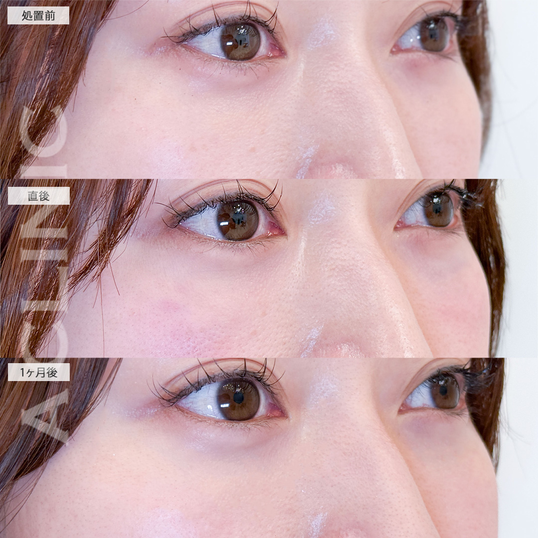 美肌サーモンスレッドで小ジワやくすみが飛び明るい目元に！こちら処置前から1ヶ月後の症例です(20代女性)