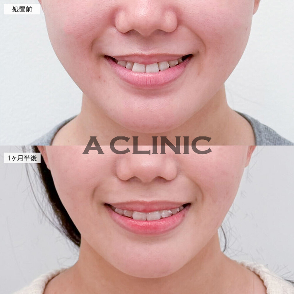 バッカルファット除去術で頬の膨らみが減りました！こちら処置前と1ヶ月半後の症例です(20代女性)