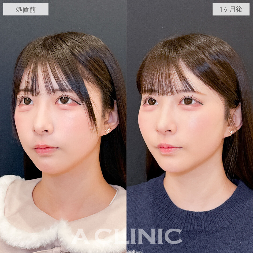 Aスレッドと頬へのヒアルロン酸注入で中顔面短縮して余白のない憧れフェイスに！こちら処置前と1か月後の症例です(20代女性)