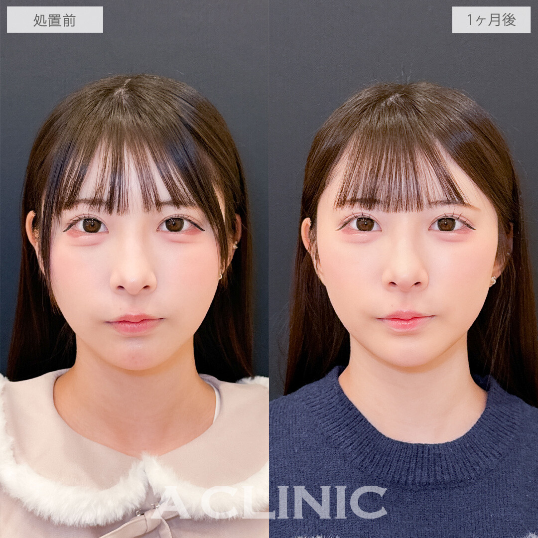 Aスレッドと頬へのヒアルロン酸注入で中顔面短縮して余白のない憧れフェイスに！こちら処置前と1か月後の症例です(20代女性)