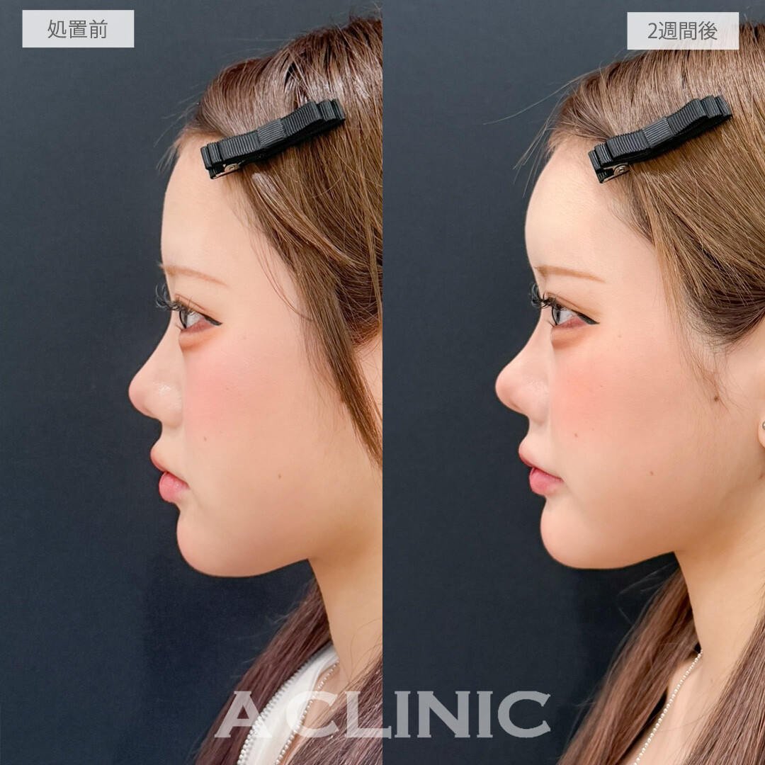 額出し(ヒアルロン酸注入)や鼻ヒアルロン酸で自分好みにお顔をアップデートできます！処置前と2週間後の症例です(20代女性)