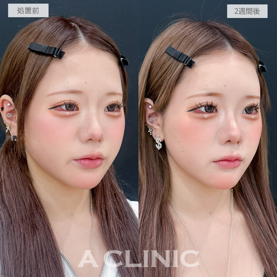 額出し(ヒアルロン酸注入)や鼻ヒアルロン酸で自分好みにお顔をアップデートできます！処置前と2週間後の症例です(20代女性)