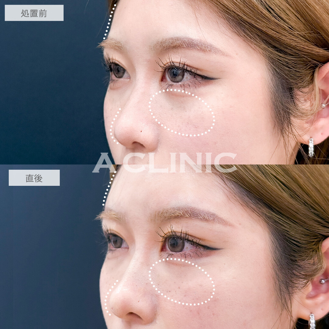 ヒアルロン酸カスタマイズメニューでお悩み一気に解決できます！こちら処置前と直後の症例です(20代女性)