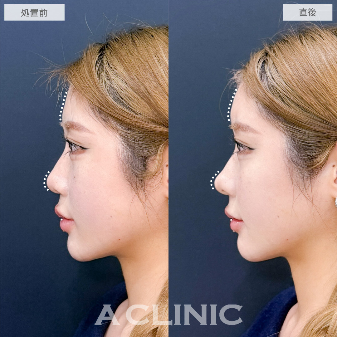 ヒアルロン酸カスタマイズメニューでお悩み一気に解決できます！こちら処置前と直後の症例です(20代女性)