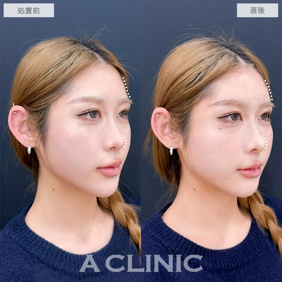 ヒアルロン酸カスタマイズメニューでお悩み一気に解決できます！こちら処置前と直後の症例です(20代女性)