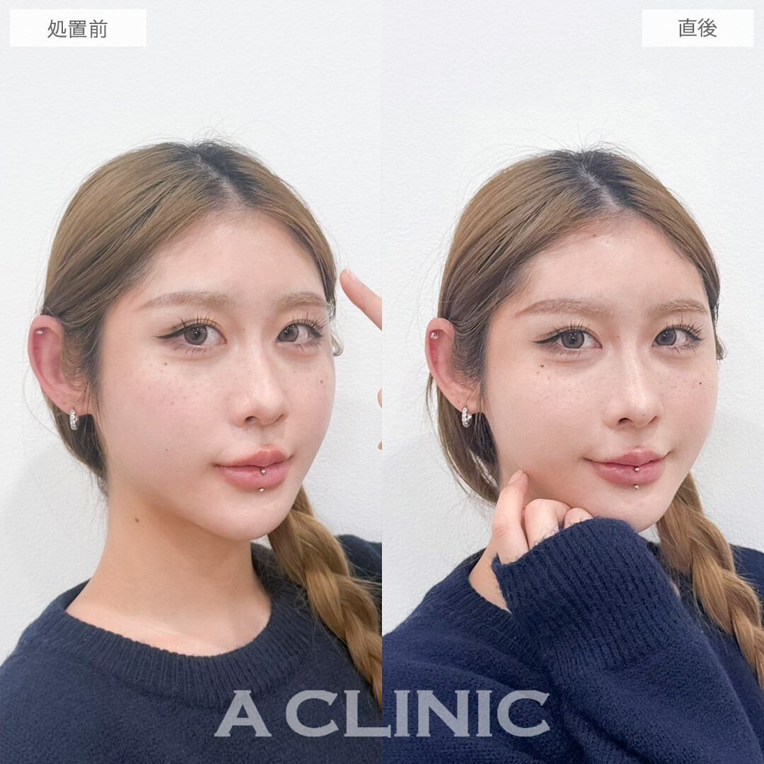 ヒアルロン酸カスタマイズメニューでお悩み一気に解決できます！こちら処置前と直後の症例です(20代女性)