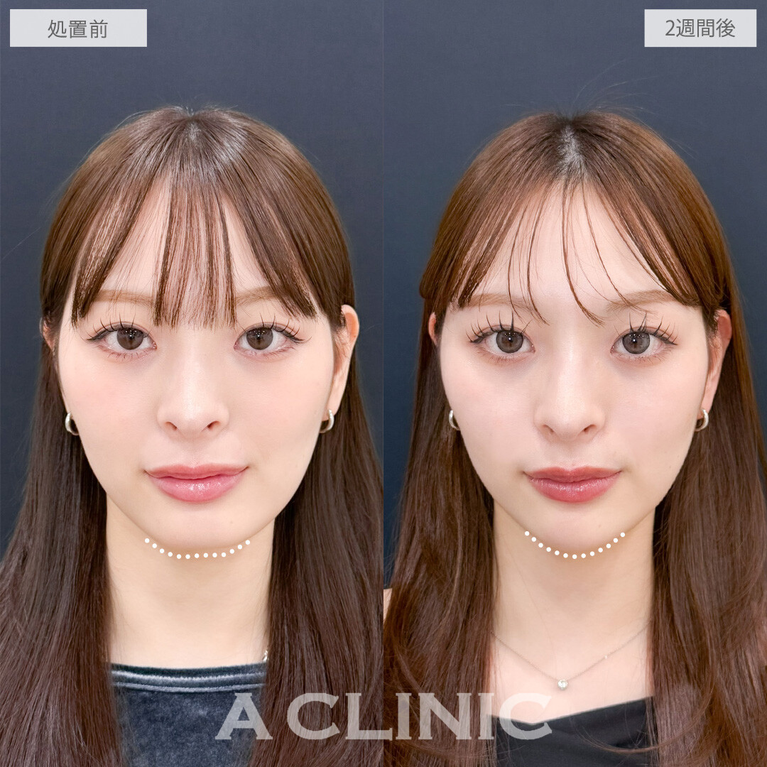 ヒアルロン酸カスタマイズメニューで全体的に立体感を出すことができます！こちら処置前と2週間後の症例です(20代女性)